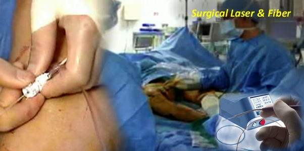 Medical Laser and Fiber System